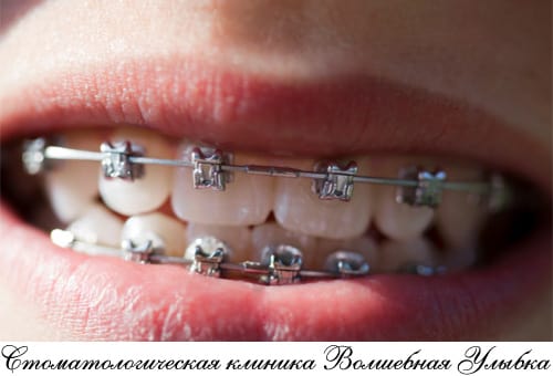 Металлическая брекет-система – нестареющая ортодонтическая классика