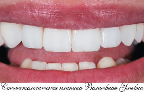Съемное протезирование зубов: функционально, быстро и недорого!