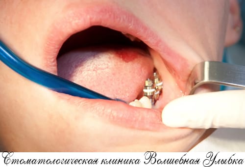 Удаление импланта зуба в Строгио