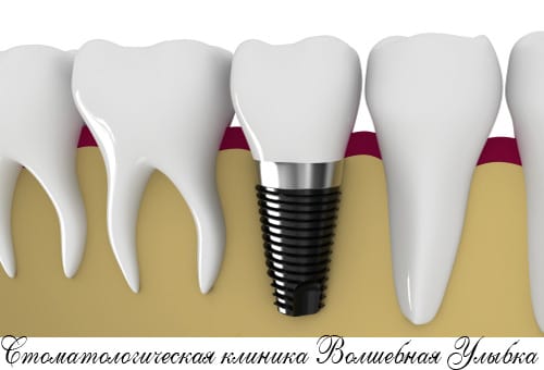 Установка штифта в зубной корень – оптимальный вариант протезирования разрушенных зубов