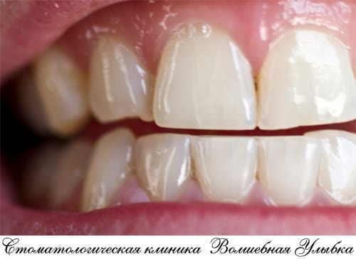 Восстановление зуба из корня – эффективный способ протезирования зубов