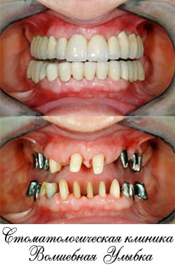 Восстановление коронковой части зуба: основные способы